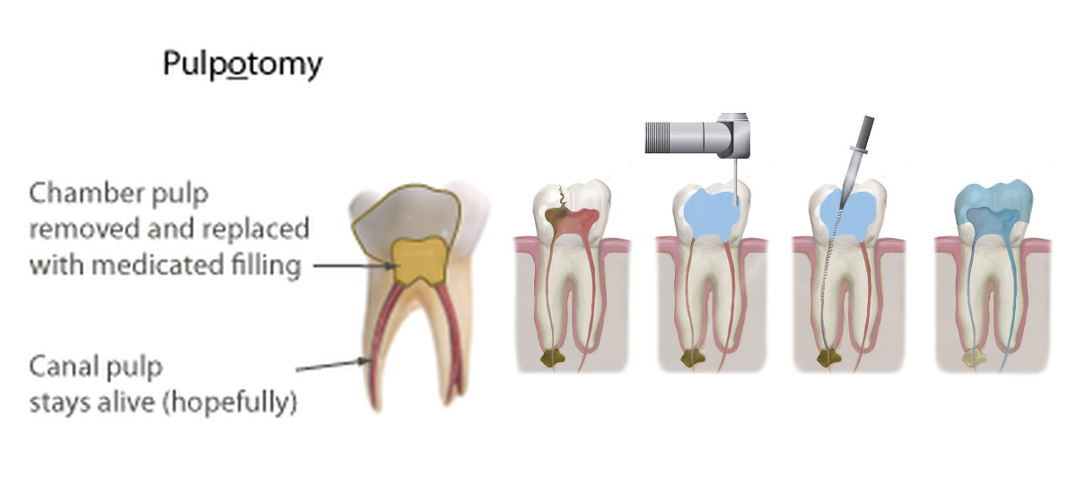 Pulp therapy – AKOTA MULTISPECIALITY DENTAL CLINIC